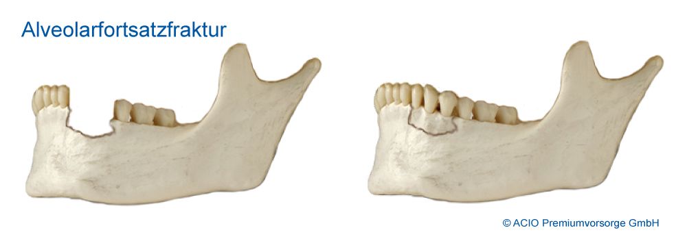 Alveolarfortsatzfraktur