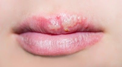 ausgeprägter Herpes simplex