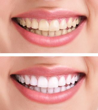 Bleaching - vor und nach dem Zahnbleaching