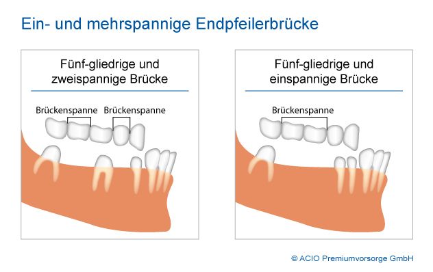 Bruecke_ein_zwei_spannig