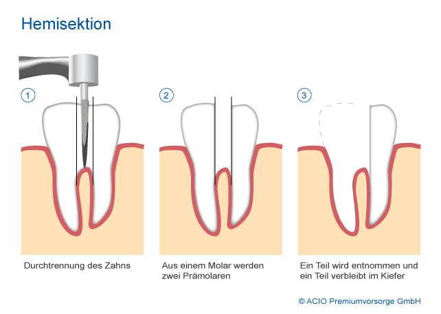 Hemisektion