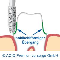 Hohlkehlpräparation