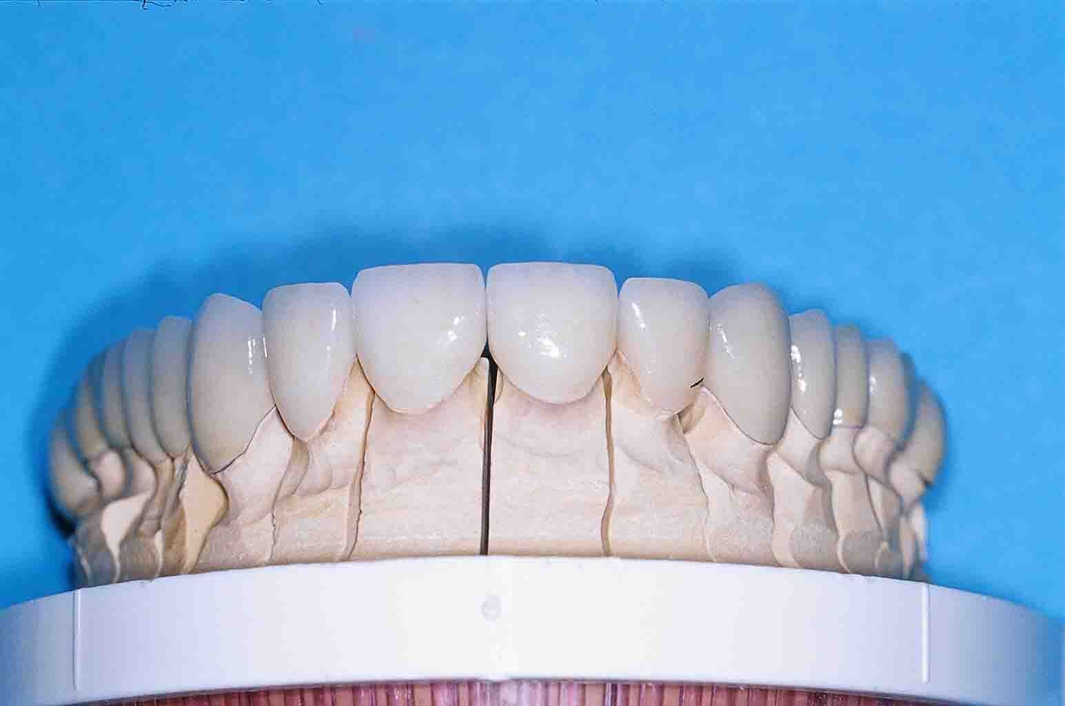 Im Dentallabor gefertigte Veneers