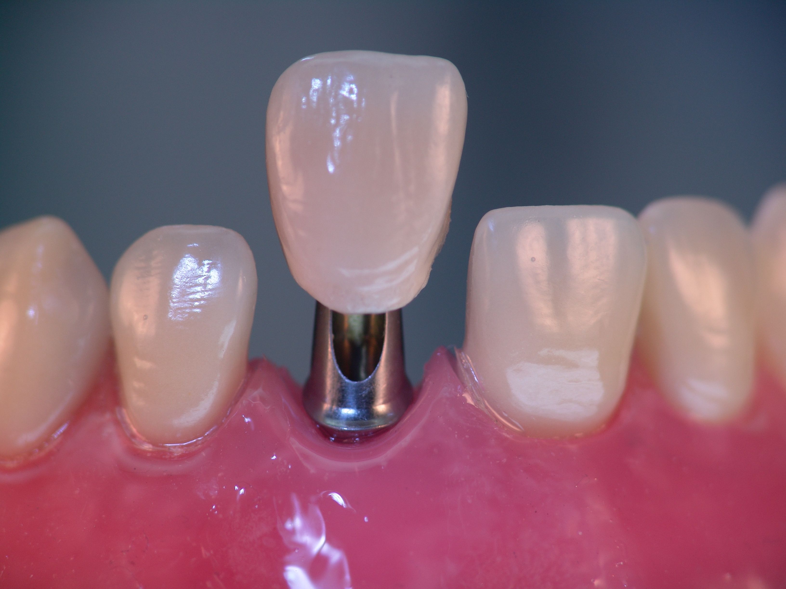 Implantate - Krone wird aufgesetzt
