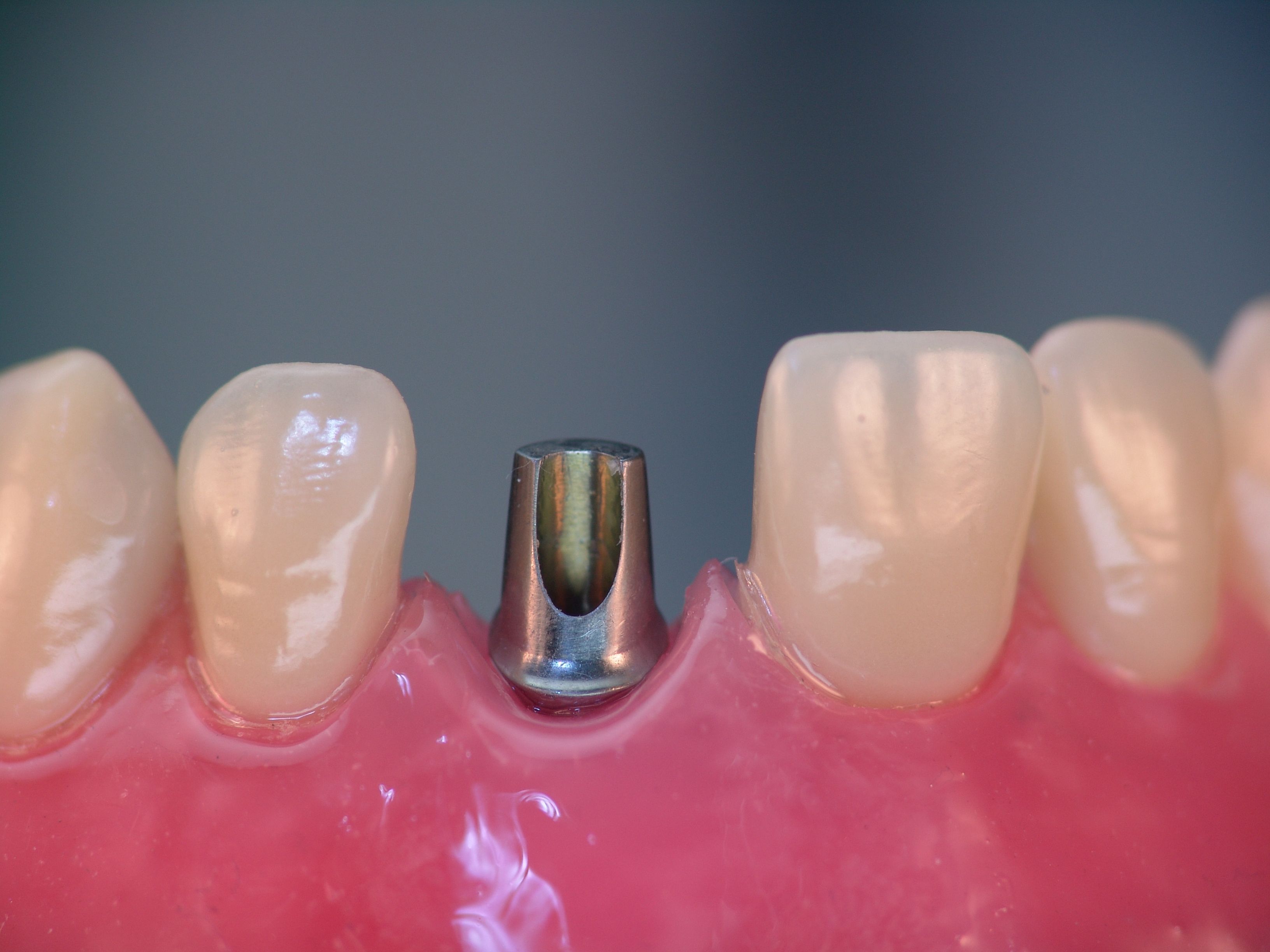 Implantate mit Aufbauelement