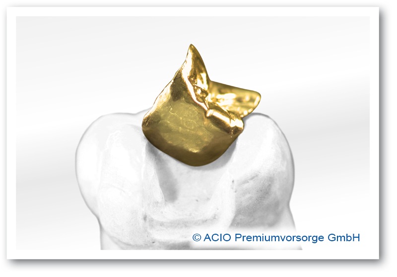 Inlay_gold_DSC06751 Kopie
