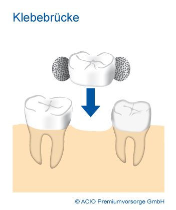 Klebebruecke