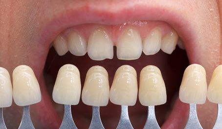 Mit Veneers zu versorgende Mundsituation