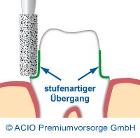 Präparation mittels eines Stufenschliffs