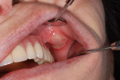 prothesenstomatitis hier Stomatitis Aphtosa
