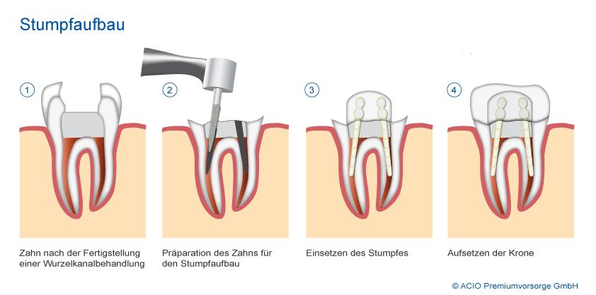 Stumpfaufbau