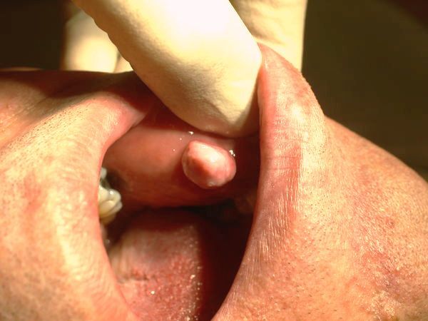 Tumor - Klaus D. Peter, Gummersbach, Germany