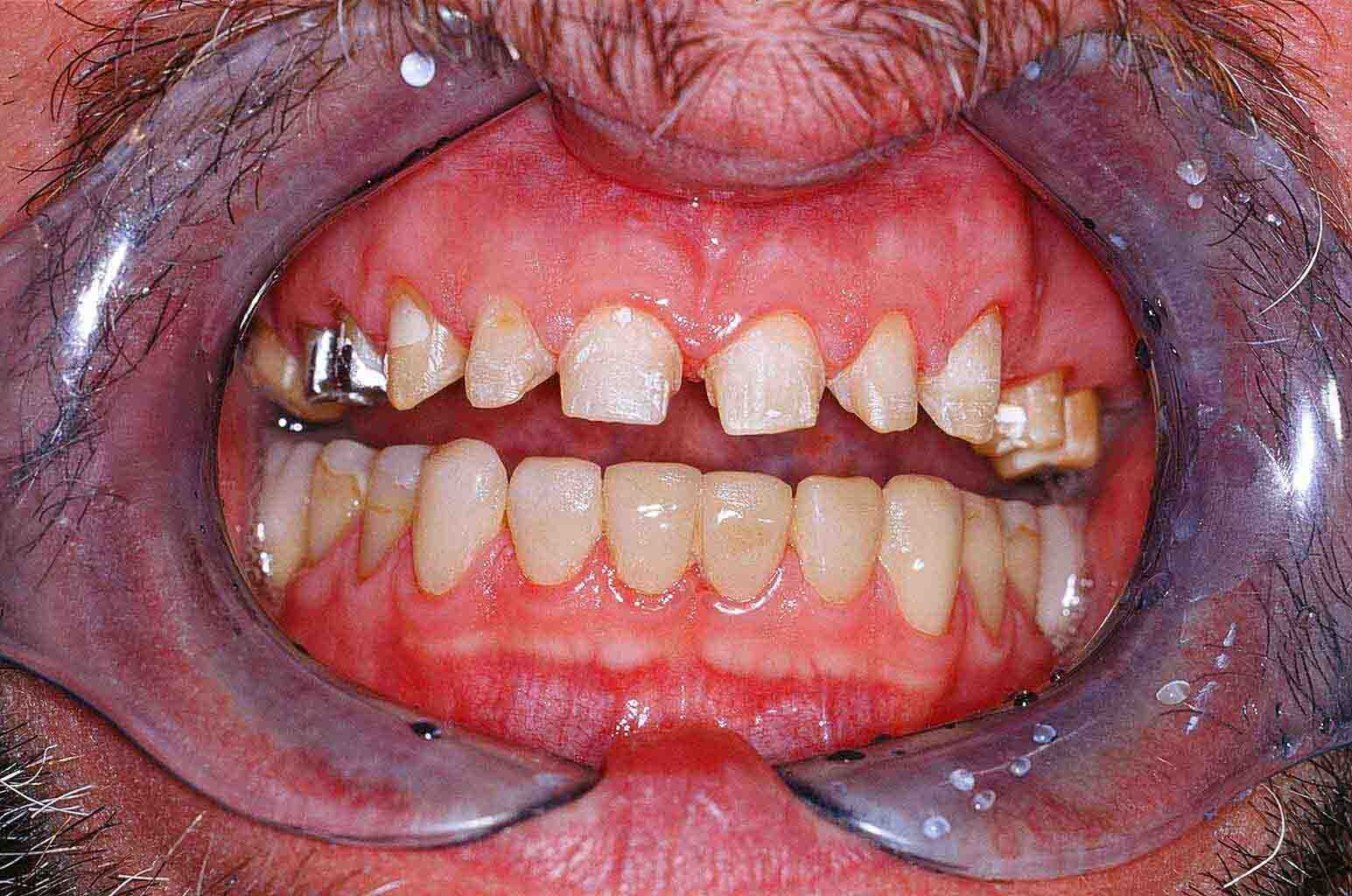 Veneers - Präparierte Zähne