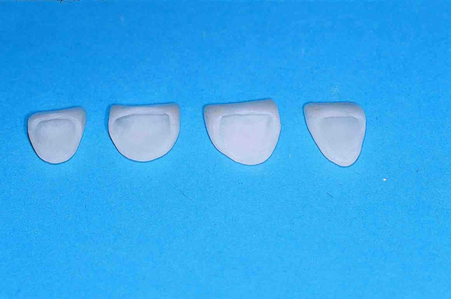 Veneers sind hauchdünne Keramikschalen
