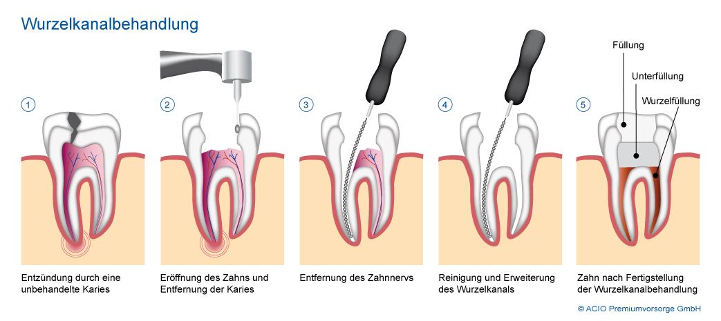 Wurzelkanalbehandlung