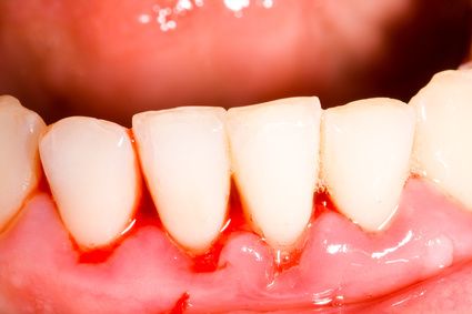 Zahnfleischbluten durch Gingivitis