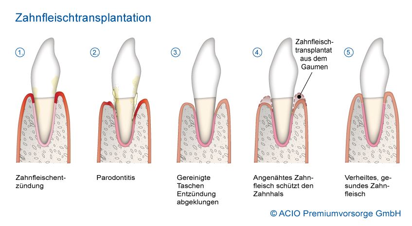 Behandlungsablauf bei einer Zahnfleischtransplantation und Schleimhauttransplantation